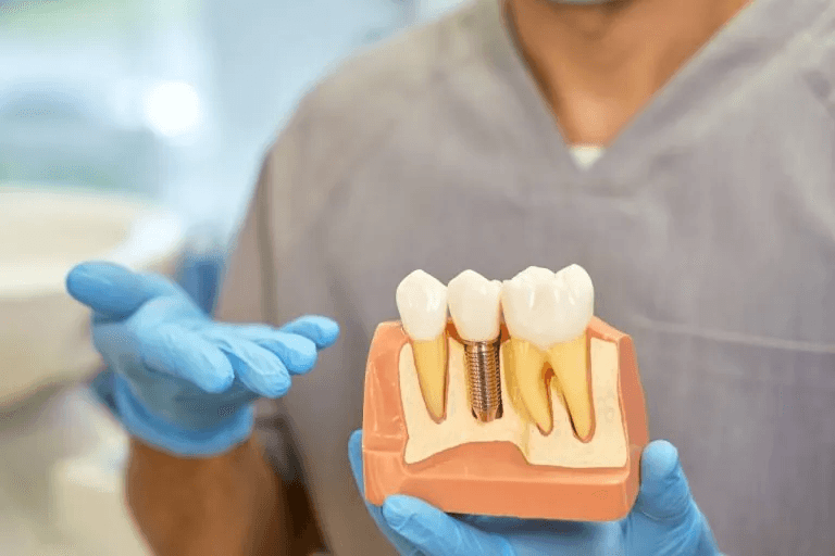 Modelo dental usado como referencia para explicar tratamientos de implantología